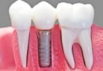 implantes dentários imagem destaque