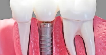 implantes dentários imagem destaque