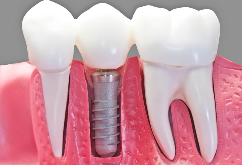 implantes dentários imagem destaque
