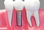 implantes dentários