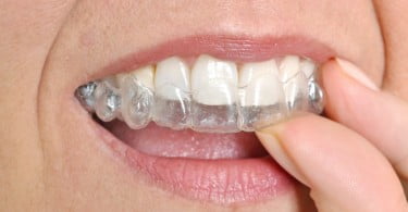 aparelho ortodôntico invisível