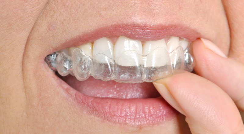 aparelho ortodôntico invisível