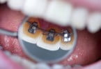 Investigadores criam material adesivo que previne cáries à volta de brackets