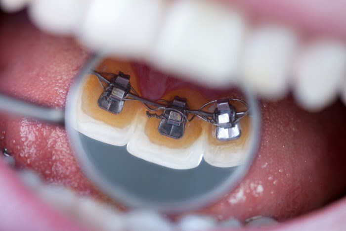 Investigadores criam material adesivo que previne cáries à volta de brackets