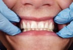 Doença periodontal pode mesmo estar relacionada com artrite reumatoide