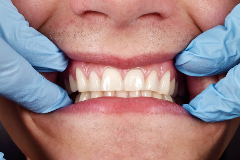 Doença periodontal pode mesmo estar relacionada com artrite reumatoide