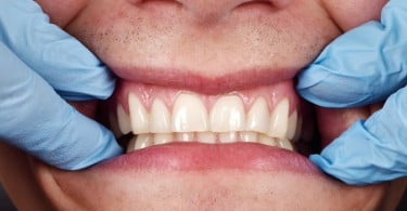 gengivas check up Saúde Oral