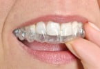 aparelho ortodôntico Saúde Oral