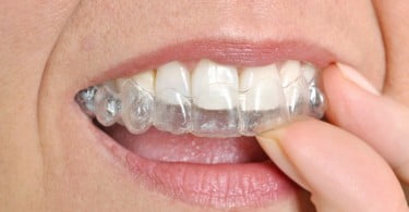 aparelho ortodôntico Saúde Oral