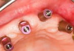 Mercado dos implantes dentários deverá valer 5,9 mil M$ em 2028