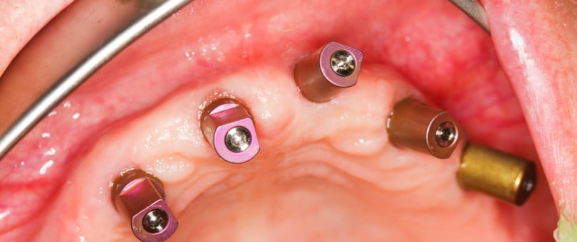 Mercado dos implantes dentários deverá valer 5,9 mil M$ em 2028