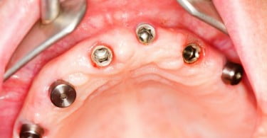 Bifosfonatos podem afetar cirurgias de implantes dentários