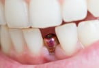Porque falham os implantes? Estudo aponta razões