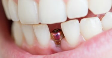 Porque falham os implantes? Estudo aponta razões