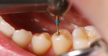 tratar cárie Saúde Oral