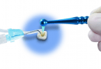 dossier de endodontia