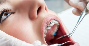 aparelhos dentários