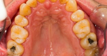 O que afeta o sucesso de uma amálgama dentária?