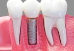 implantes dentários Saúde Oral