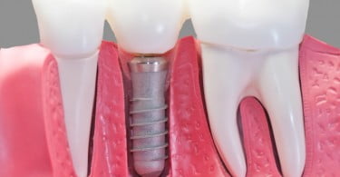 implantes dentários Saúde Oral