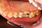 cáries dentárias