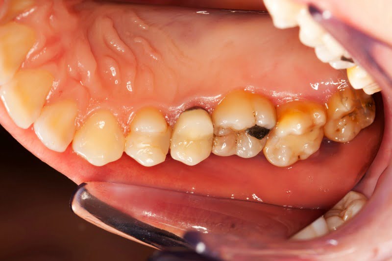 cáries dentárias