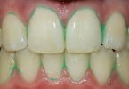 dentes pasta de dentes Plaque HD Saúde Oral