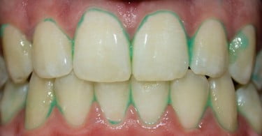 dentes pasta de dentes Plaque HD Saúde Oral