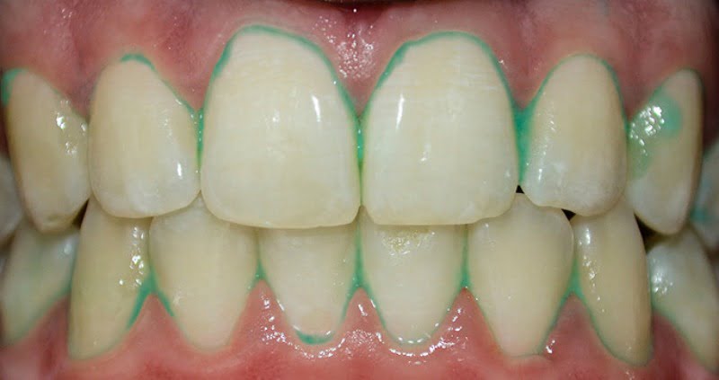 dentes pasta de dentes Plaque HD Saúde Oral