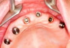 Malo Clinic Education realiza nova edição do ‘Curso Teórico-Prático de Manutenção de Implantes’