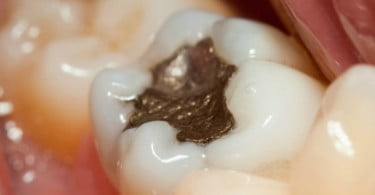 Amálgama é cada vez menos usada na Nova Zelândia