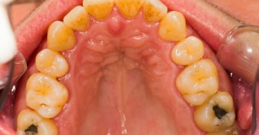 amálgamas dentárias Saúde Oral