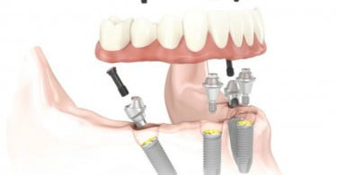 implantes dentário all on  Nobel Saúde Oral