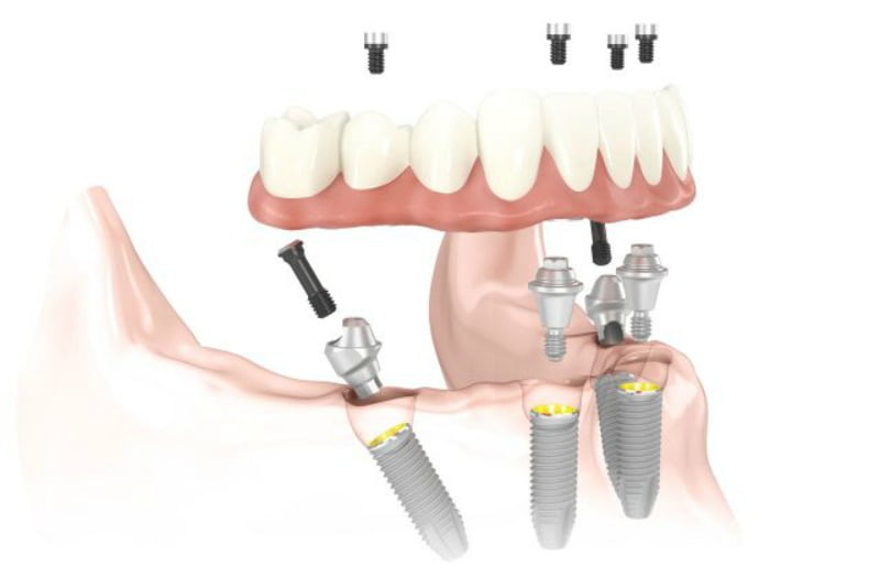 implantes dentário all on  Nobel Saúde Oral