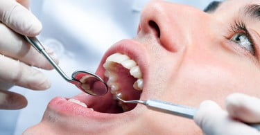 Reino Unido: 170 jovens extraíram pelo menos um dente por dia no SNS