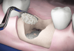 OsteoBiol apresenta Gen-Os + TSV Gel, a combinação ideal para a estabilização de enxertos