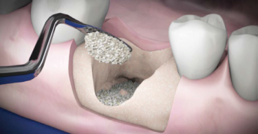 OsteoBiol apresenta Gen-Os + TSV Gel, a combinação ideal para a estabilização de enxertos