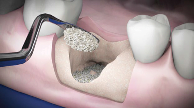 OsteoBiol apresenta Gen-Os + TSV Gel, a combinação ideal para a estabilização de enxertos