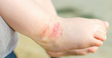 ligação entre a dermatite atópica e as cáries dentárias