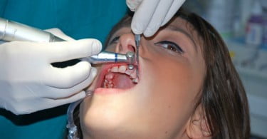 doença periodontal Saúde Oral