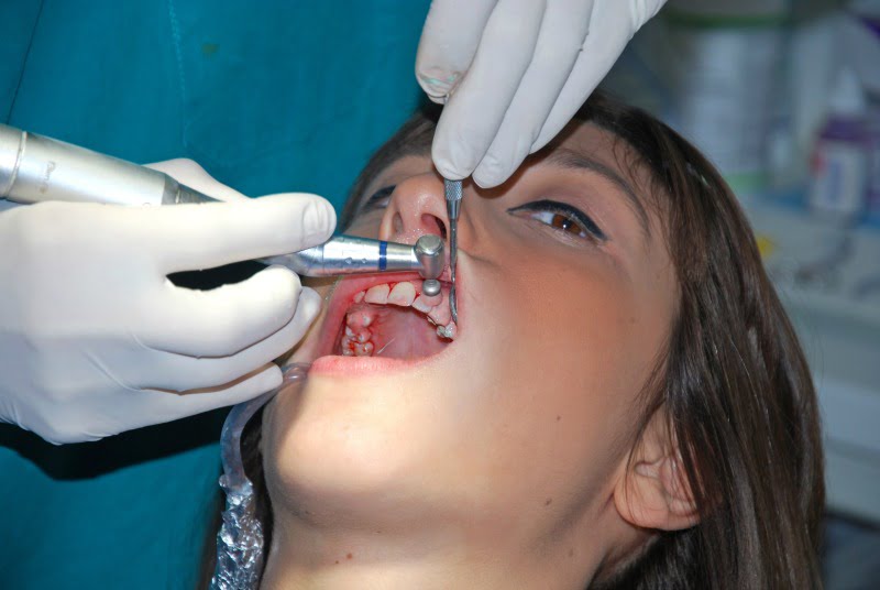 doença periodontal Saúde Oral
