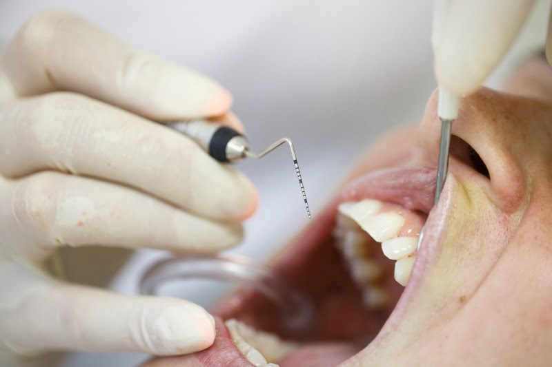 periodontite tratamento Saúde Oral