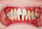 periodontite Saúde Oral