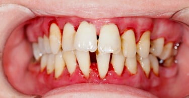 periodontite Saúde Oral