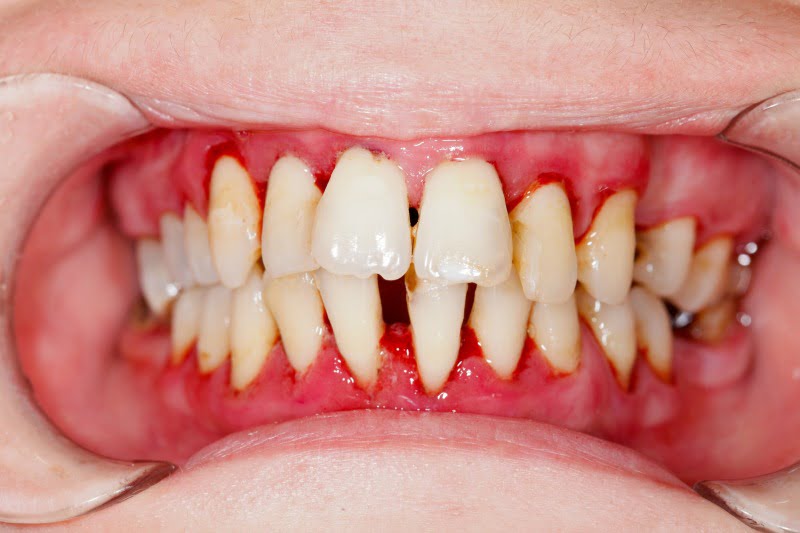 periodontite Saúde Oral