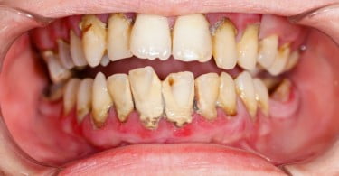 periodontite Saúde Oral