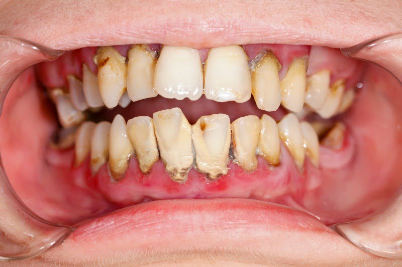 periodontite Saúde Oral