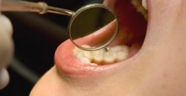 disfunção teporomandibular Saúde Oral