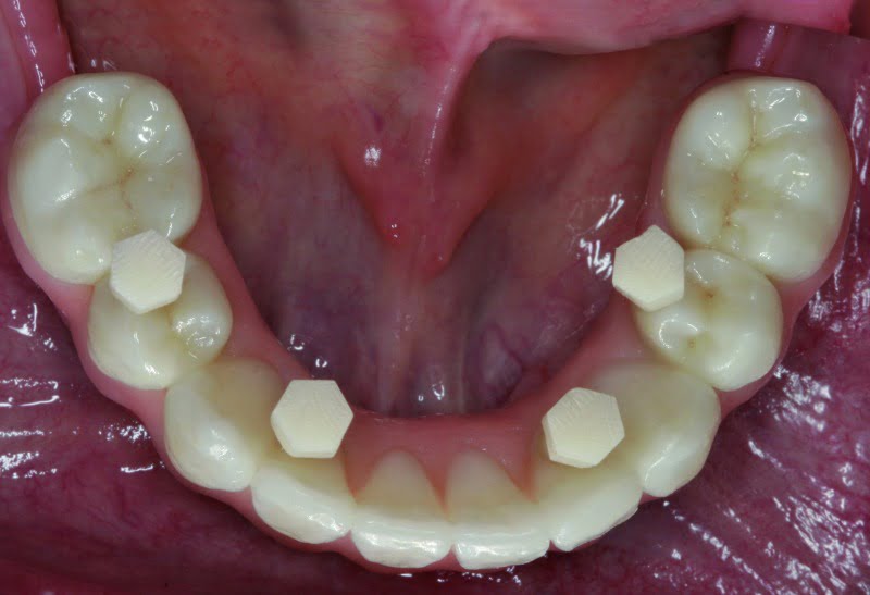 Parafusos de selagem Zirkonzhan