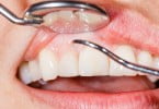 doenças periodontais Saúde Oral
